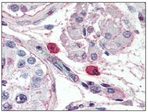 Immunohistochemistry: FCER1A antibody staining of Formalin-Fixed, Paraffin-Embedded Human Mast Cells at 10 ug/ml followed by biotinylated anti-mouse IgG secondary antibody, alkaline phosphatase-streptavidin and chromogen.
