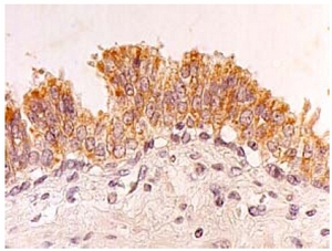 Figure 3. Immunohistochemical detection of FHL2 on Paraffin Embedded section of a Human prostate cancer with FHL2 antibody (AM20016AF-N).