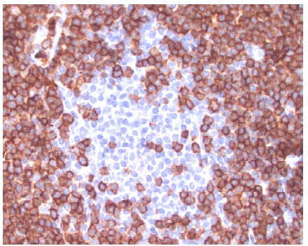 Formalin-Fixed Paraffin-Embedded Human Skin stained with SMAD3 antibody at 2.5ug/ml after heat-induced antigen retrieval. Antibody LS-B64 concentration 5ug/ml.