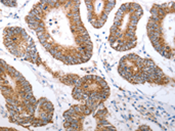 Immunohistochemistry of paraffin-embedded Human colon cancer tissue using TA321362 (HCRTR1 Antibody) at dilution 1/70 (Original magnification: x200)