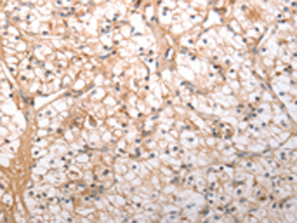 Immunohistochemistry of paraffin-embedded Human renal cancer tissue using TA321363 (HCRTR1 Antibody) at dilution 1/100 (Original magnification: x200)