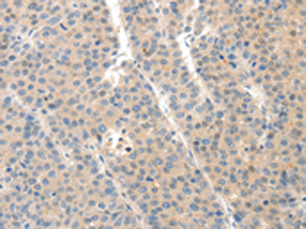 Immunohistochemistry of paraffin-embedded Human liver cancer tissue using TA321712 (SLC20A1 Antibody) at dilution 1/40 (Original magnification: x200)