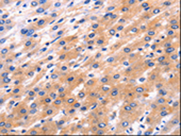 Immunohistochemistry of paraffin-embedded Human liver cancer tissue using TA321858 (RAB39A Antibody) at dilution 1/5 (Original magnification: x200)