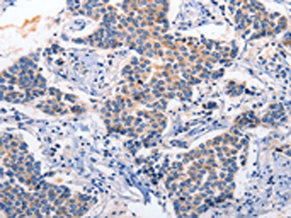 Immunohistochemistry of paraffin-embedded Human breast cancer tissue using TA321859 (RAB39A Antibody) at dilution 1/5 (Original magnification: x200)