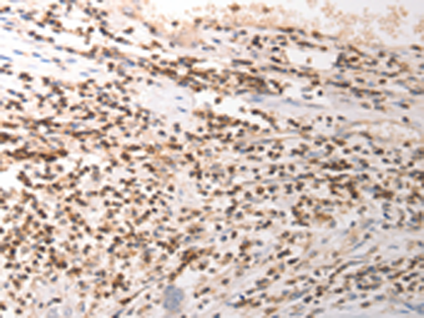 Immunohistochemistry of paraffin-embedded Human gasrtic cancer tissue using TA321904 (VTCN1 Antibody) at dilution 1/25 (Original magnification: x200)