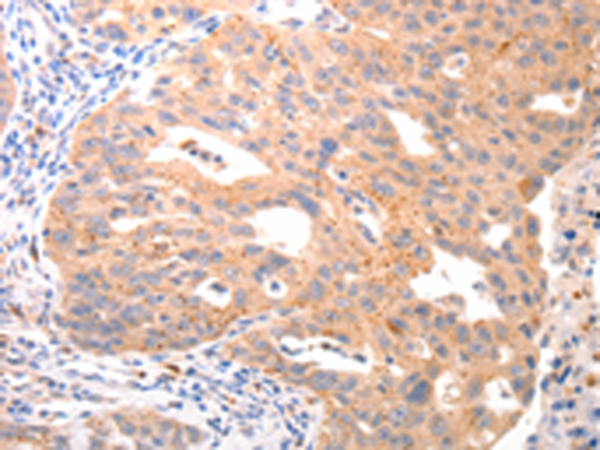 Immunohistochemistry of paraffin-embedded Human ovarian cancer tissue using TA321905 (VTCN1 Antibody) at dilution 1/20 (Original magnification: x200)