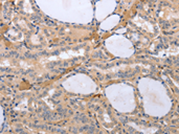 Immunohistochemistry of paraffin-embedded Human thyroid cancer tissue using TA321949 (TYROBP Antibody) at dilution 1/30 (Original magnification: x200)