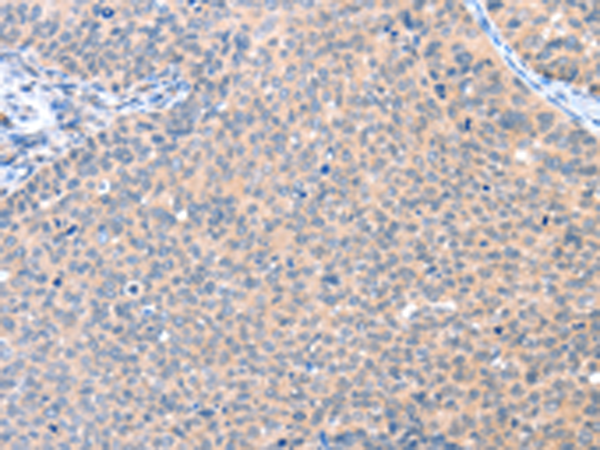 Immunohistochemistry of paraffin-embedded Human cervical cancer tissue using TA321954 (AADACL2 Antibody) at dilution 1/25 (Original magnification: x200)