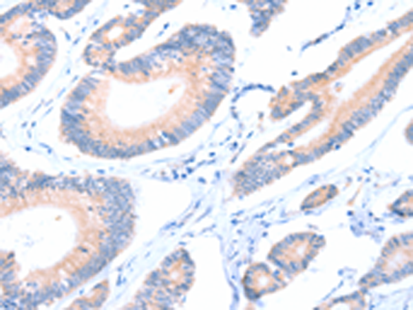 Immunohistochemistry of paraffin-embedded Human colon cancer tissue using TA321955 (AADACL2 Antibody) at dilution 1/25 (Original magnification: x200)