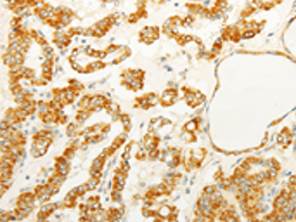 Immunohistochemistry of paraffin-embedded Human thyroid cancer tissue using TA321975 (FOXR2 Antibody) at dilution 1/25 (Original magnification: x200)
