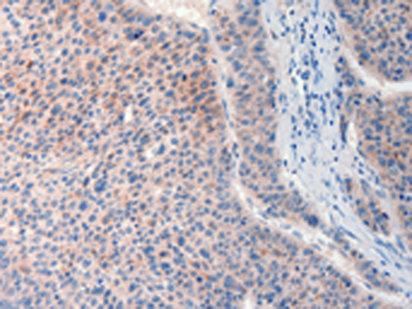 Immunohistochemistry of paraffin-embedded Human liver cancer tissue using TA322181 (FAT4 Antibody) at dilution 1/20 (Original magnification: x200)