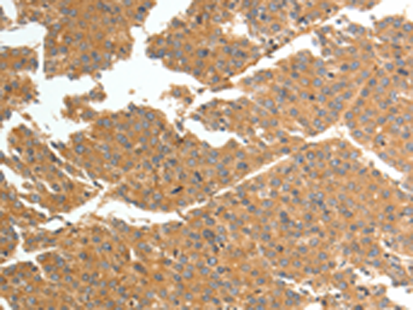 Immunohistochemistry of paraffin-embedded Human liver cancer tissue using TA322209 (TNN Antibody) at dilution 1/50 (Original magnification: x200)