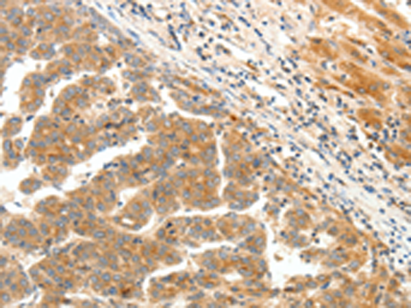 Immunohistochemistry of paraffin-embedded Human liver cancer tissue using TA322257 (LPAR5 Antibody) at dilution 1/25 (Original magnification: x200)
