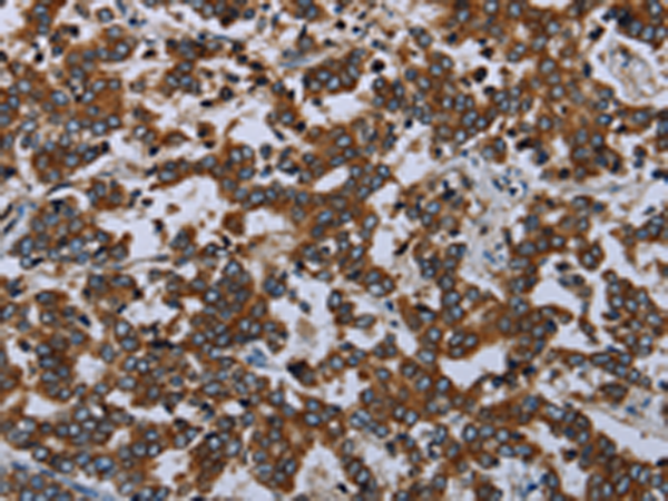 Immunohistochemistry of paraffin-embedded Human liver cancer tissue using TA322258 (AVEN Antibody) at dilution 1/20 (Original magnification: x200)