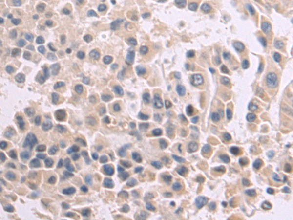 Immunohistochemistry of paraffin-embedded Human liver cancer tissue using TA322323 (CLEC1A Antibody) at dilution 1/80 (Original magnification: x200)