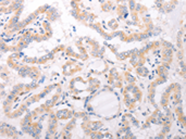 IHC: The human prostate tissue stained with Mouse anti-PSAP monoclonal antibody at 1:50. (Note: formalinfixed, paraffin-embedded sections need 15 minutes heatinduced epitope retrieval in 10 mM citrate buffer, pH 6.0, and 30 minutes incubation at room temperature with the primary antibody.