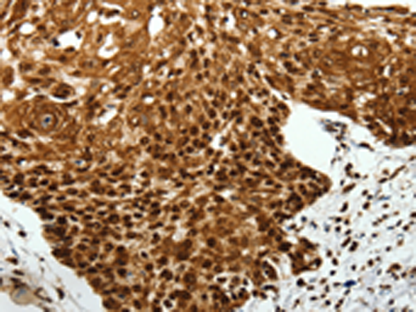 Immunohistochemistry of paraffin-embedded Human cervical cancer tissue using TA322393 (SCN1A Antibody) at dilution 1/40 (Original magnification: x200)