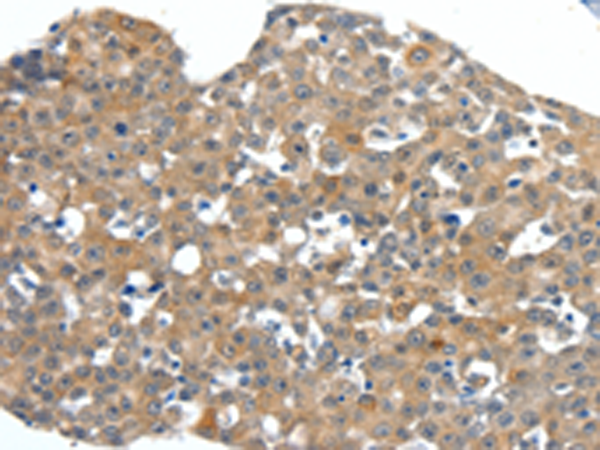 Immunohistochemistry of paraffin-embedded Human esophagus cancer tissue using TA322395 (SCN11A Antibody) at dilution 1/40 (Original magnification: x200)