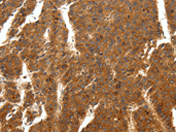 Immunohistochemistry of paraffin-embedded Human breast cancer tissue using TA322396 (SCN11A Antibody) at dilution 1/50 (Original magnification: x200)