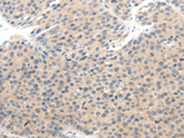 Immunohistochemistry of paraffin-embedded Human breast cancer tissue using TA322485 (SCN10A Antibody) at dilution 1/25 (Original magnification: x200)
