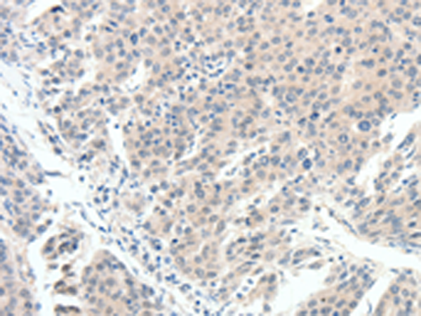 Immunohistochemistry of paraffin-embedded Human breast cancer tissue using TA322486 (SCN10A Antibody) at dilution 1/20 (Original magnification: x200)
