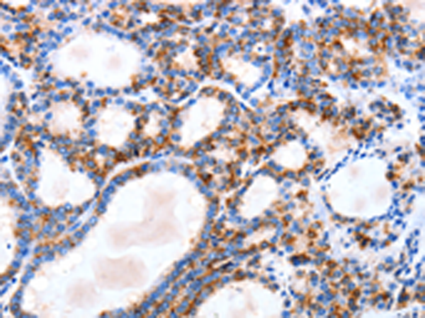 Immunohistochemistry of paraffin-embedded Human thyroid cancer tissue using TA322553 (IGSF6 Antibody) at dilution 1/10 (Original magnification: x200)