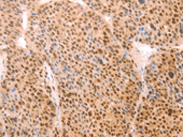 Immunohistochemistry of paraffin-embedded Human liver cancer tissue using TA322556 (ALYREF Antibody) at dilution 1/15 (Original magnification: x200)