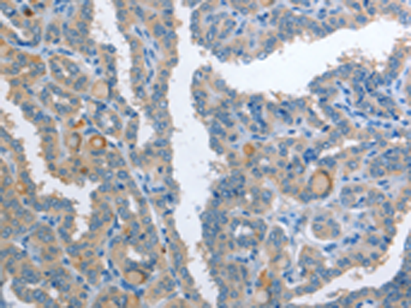 Immunohistochemistry of paraffin-embedded Human thyroid cancer tissue using TA322803 (AP2S1 Antibody) at dilution 1/25 (Original magnification: x200)