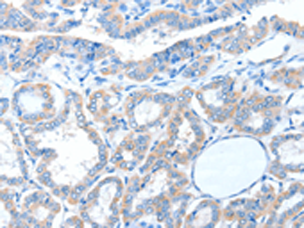 Immunohistochemistry of paraffin-embedded Human thyroid cancer tissue using TA322820 (ADAM21 Antibody) at dilution 1/15 (Original magnification: x200)