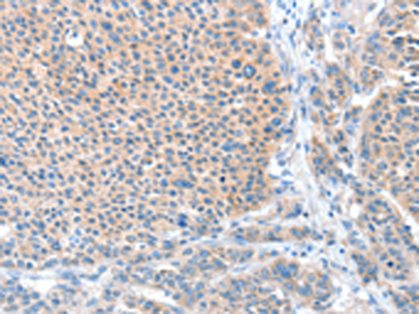 Immunohistochemistry of paraffin-embedded Human liver cancer tissue using TA322821 (ADAM20 Antibody) at dilution 1/50 (Original magnification: x200)