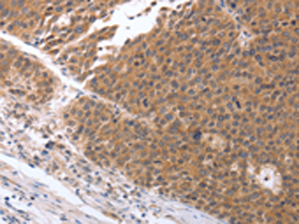 Immunohistochemistry of paraffin-embedded Human ovarian cancer tissue using TA322835 (GEMIN2 Antibody) at dilution 1/25 (Original magnification: x200)