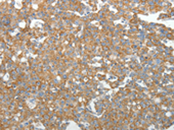 Immunohistochemistry of paraffin-embedded Human breast cancer tissue using TA322837 (GEMIN2 Antibody) at dilution 1/40 (Original magnification: x200)