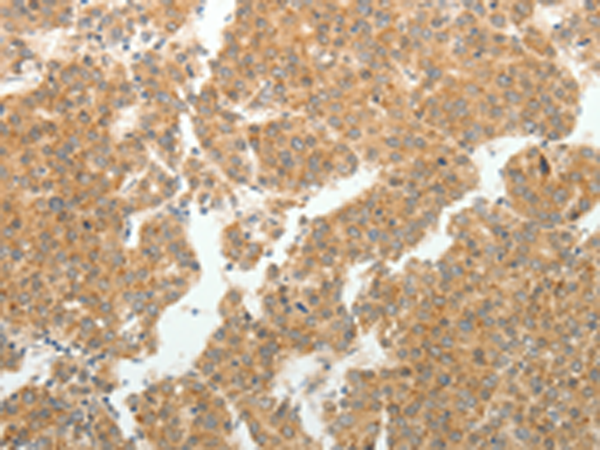 Immunohistochemistry of paraffin-embedded Human liver cancer tissue using TA322838 (GEMIN2 Antibody) at dilution 1/40 (Original magnification: x200)