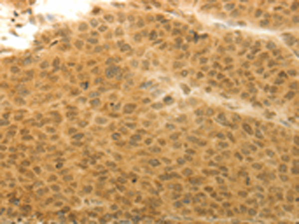 Immunohistochemistry of paraffin-embedded Human liver cancer tissue using TA323052 (HOXA4 Antibody) at dilution 1/20 (Original magnification: x200)