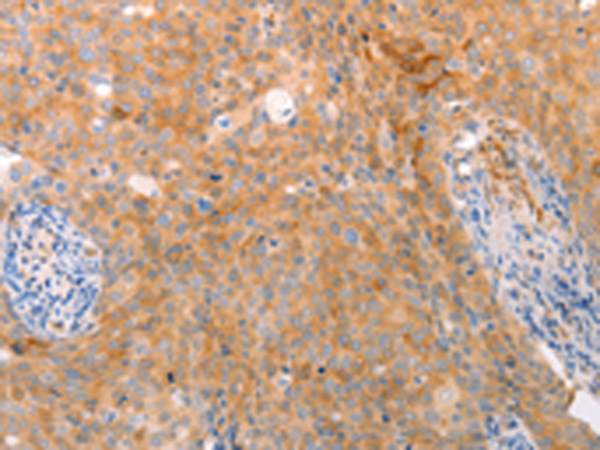 Immunohistochemistry of paraffin-embedded Human cervical cancer tissue using TA323146 (ABCA2 Antibody) at dilution 1/25 (Original magnification: x200)