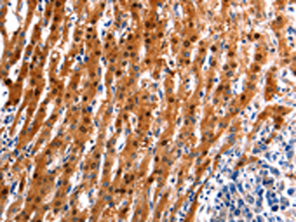 Immunohistochemistry of paraffin-embedded Human liver cancer tissue using TA323153 (ID4 Antibody) at dilution 1/20 (Original magnification: x200)