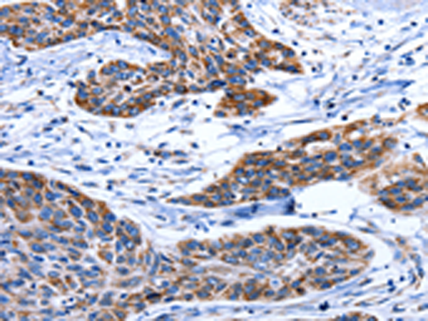 Immunohistochemistry of paraffin-embedded Human esophagus cancer tissue using TA323214 (AQP8 Antibody) at dilution 1/75 (Original magnification: x200)