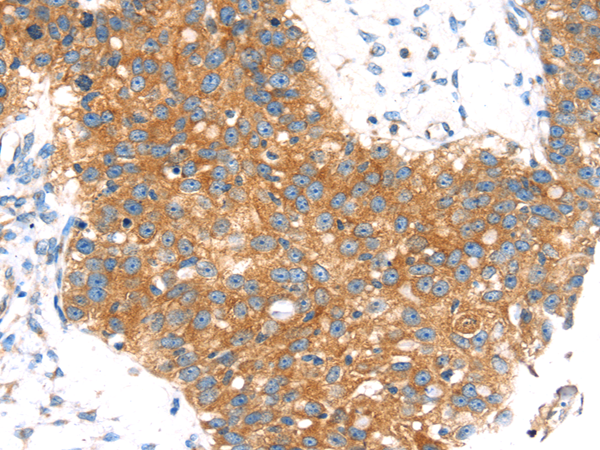 Immunohistochemistry of paraffin-embedded Human breast cancer tissue using TA323223 (AP1G1 Antibody) at dilution 1/30 (Original magnification: x200)
