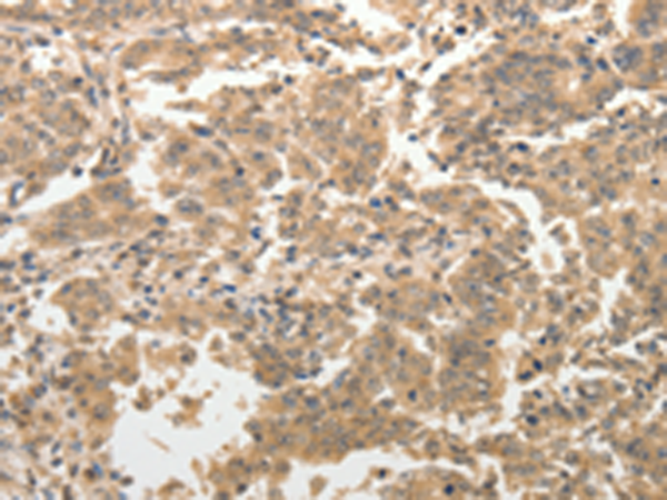 Immunohistochemistry of paraffin-embedded Human gasrtic cancer tissue using TA323233 (ADAR Antibody) at dilution 1/40 (Original magnification: x200)