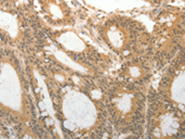 Immunohistochemistry of paraffin-embedded Human colon cancer tissue using TA323234 (ADAR Antibody) at dilution 1/25 (Original magnification: x200)