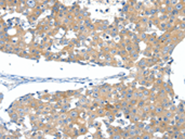 Immunohistochemistry of paraffin-embedded Human breast cancer tissue using TA323275 (SSTR3 Antibody) at dilution 1/40 (Original magnification: x200)