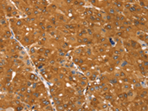 Immunohistochemistry of paraffin-embedded Human ovarian cancer tissue using TA323276 (SSTR3 Antibody) at dilution 1/30 (Original magnification: x200)