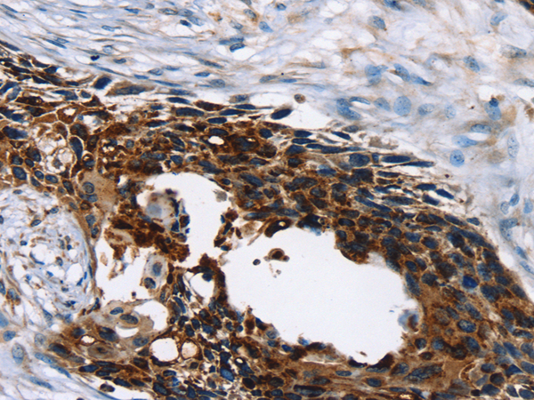 Immunohistochemistry of paraffin-embedded Human esophagus cancer tissue using TA323388 (AP1G1 Antibody) at dilution 1/45 (Original magnification: x200)