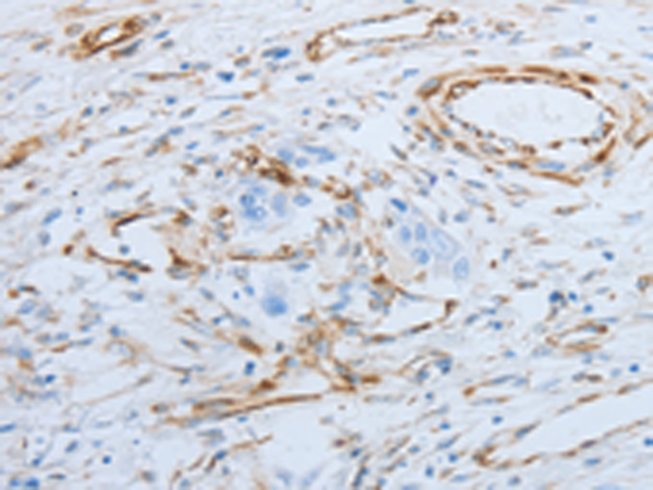 Immunohistochemistry of paraffin-embedded Human esophagus cancer tissue using TA323392 (SPINT1 Antibody) at dilution 1/25 (Original magnification: x200)