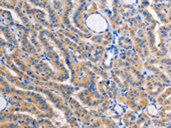 Immunohistochemistry of paraffin-embedded Human thyroid cancer tissue using TA323479 (ALG8 Antibody) at dilution 1/30 (Original magnification: x200)