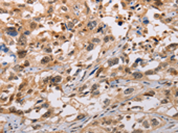 Immunohistochemistry of paraffin-embedded Human esophagus cancer tissue using TA323936 (ADAMDEC1 Antibody) at dilution 1/20 (Original magnification: x200)