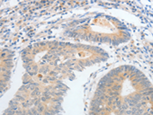 Immunohistochemistry of paraffin-embedded Human colon cancer tissue using TA323969 (CALCR Antibody) at dilution 1/25 (Original magnification: x200)