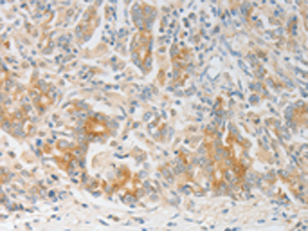 Immunohistochemistry of paraffin-embedded Human gasrtic cancer tissue using TA323970 (CALCR Antibody) at dilution 1/20 (Original magnification: x200)