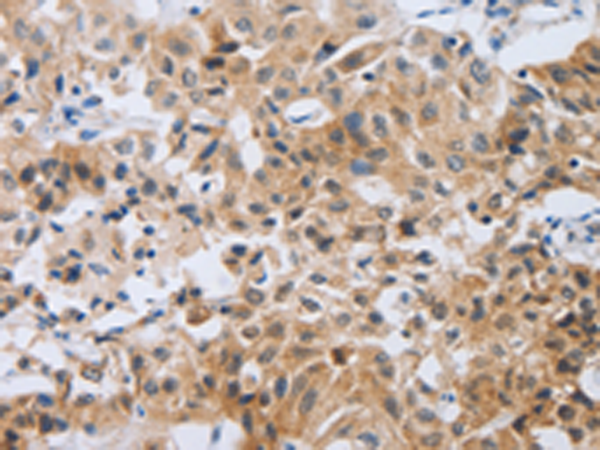 Immunohistochemistry of paraffin-embedded Human lung cancer tissue using TA324106 (NEB Antibody) at dilution 1/80 (Original magnification: x200)
