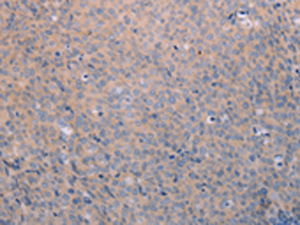 Immunohistochemistry of paraffin-embedded Human cervical cancer tissue using TA324215 (ANKRD26 Antibody) at dilution 1/25 (Original magnification: x200)